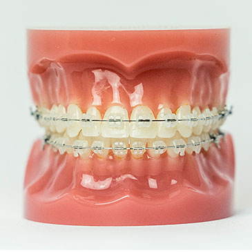 Ceramic Braces